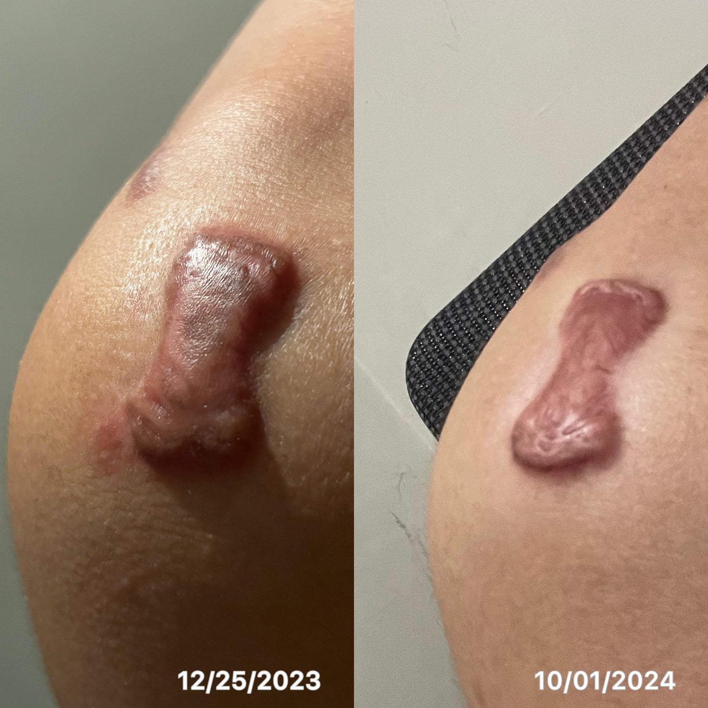 🇯🇵Japan♥HISAMITSU Hisamitsu Ogawa Scar Repair and Removal Patch
HISAMITSU Eclar Plaster Keloid Scar Remover \ Any scar savior! Hong Kong doctors recommend scar removal patches/
Hisamitsu's 薬エクラープラスター 20μg/cm2