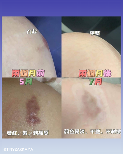 🇯🇵Japan♥HISAMITSU Hisamitsu Ogawa Scar Repair and Removal Patch
 HISAMITSU Eclar Plaster Keloid Scar Remover \ Any scar savior! Hong Kong doctors recommend scar removal patches/
 Hisamitsu's 薬エクラープラスター 20μg/cm2