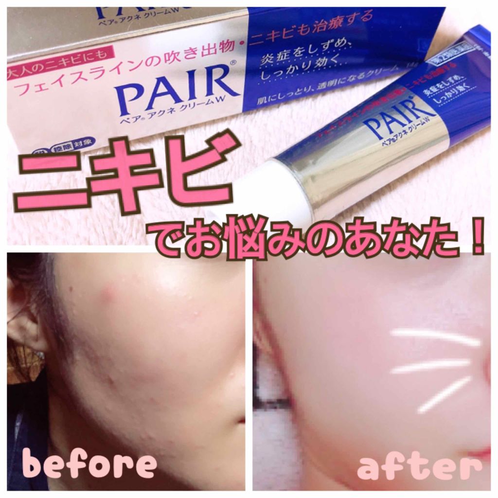 🇯🇵日本｜鎮痛消炎，從根本治好暗瘡｜PAIR 暗瘡膏 Acne Medication ペア アクネクリームW