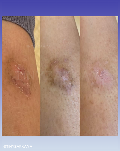 🇯🇵Japan♥HISAMITSU Hisamitsu Ogawa Scar Repair and Removal Patch
 HISAMITSU Eclar Plaster Keloid Scar Remover \ Any scar savior! Hong Kong doctors recommend scar removal patches/
 Hisamitsu's 薬エクラープラスター 20μg/cm2