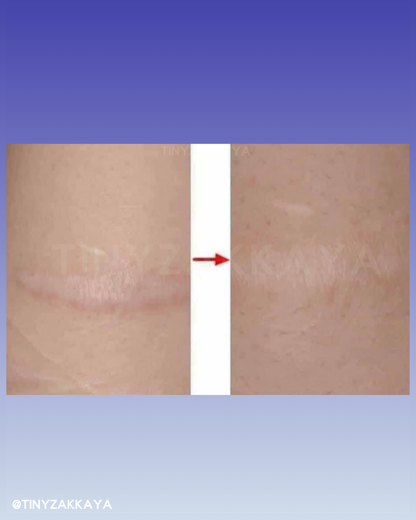 🇯🇵Japan♥HISAMITSU Hisamitsu Ogawa Scar Repair and Removal Patch
 HISAMITSU Eclar Plaster Keloid Scar Remover \ Any scar savior! Hong Kong doctors recommend scar removal patches/
 Hisamitsu's 薬エクラープラスター 20μg/cm2