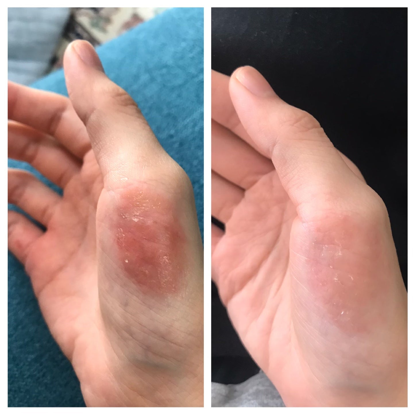 🇯🇵日本｜專門針對濕疹,皮膚炎,主婦手，連續用幾日即可見效｜田邊三菱制藥 FLUCORT F 濕疹 成人/小童 Mitsubishi Tanabe Pharma Coat f AT FLUCORT  F Ointment  フルコートf