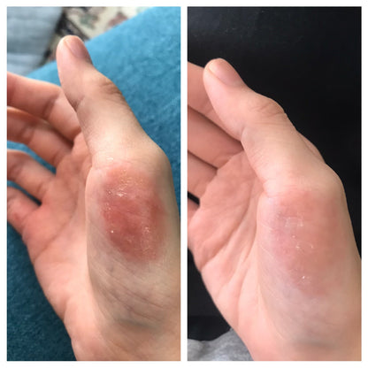 🇯🇵日本｜專門針對濕疹,皮膚炎,主婦手，連續用幾日即可見效｜田邊三菱制藥 FLUCORT F 濕疹 成人/小童 Mitsubishi Tanabe Pharma Coat f AT FLUCORT  F Ointment  フルコートf