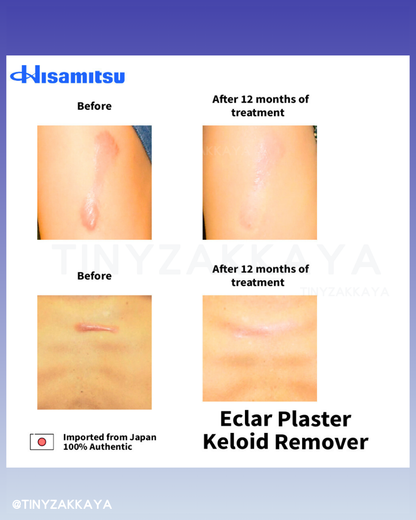 🇯🇵Japan♥HISAMITSU Hisamitsu Ogawa Scar Repair and Removal Patch
 HISAMITSU Eclar Plaster Keloid Scar Remover \ Any scar savior! Hong Kong doctors recommend scar removal patches/
 Hisamitsu's 薬エクラープラスター 20μg/cm2