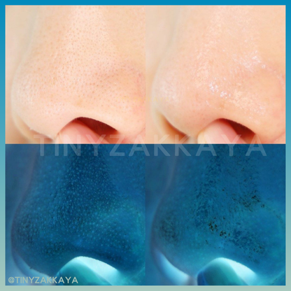 🇰🇷Korea ILSO Deep Clean Master｜Apply and then scrape, blackhead-eliminating, out-of-stock | Stainless steel blackhead scraper