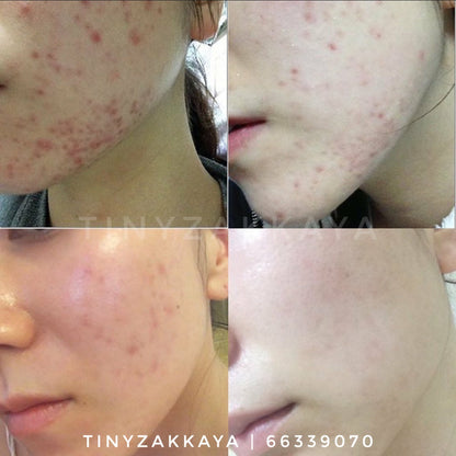 SALE 🇰🇷韓國 全新包裝｜可以去掉80%所有疤痕｜NOSCARNA 神奇祛印袪疤膏20g Dong-A Pharm Noscarna Acne Scars Removal Gel