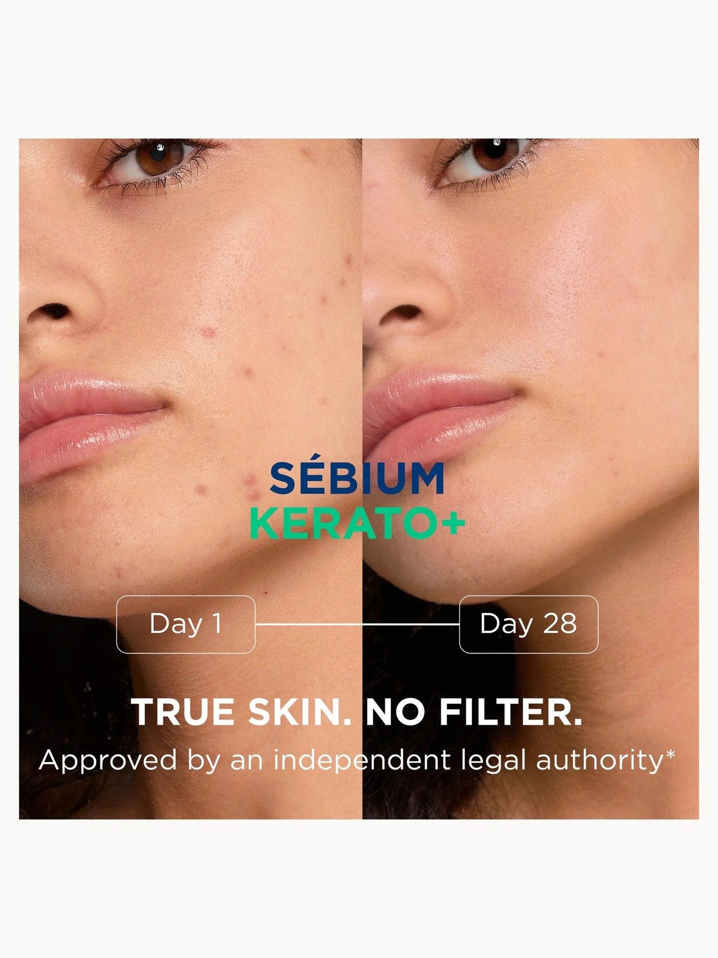 🇪🇺歐美 ♥ BIODERMA Sebium Kerato+ Anti-Blemish Gel Cream For Acne Prone Skin 3D水楊酸控油粉刺淨痘除印保濕啫喱霜精華 30ml ＼油痘肌、粉刺肌的救星！告別惱人瑕疵，重現平滑細緻的好膚質！／